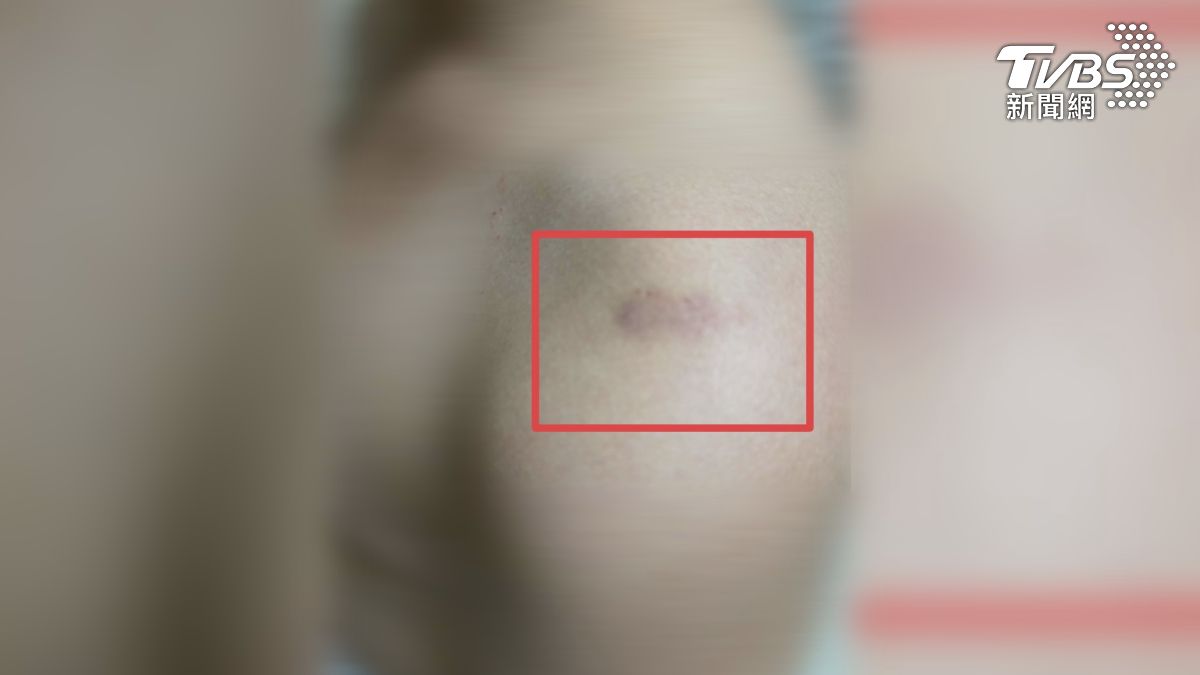 高雄有家長指控，國二的兒子被班導針對，只因為朝會跟同學講話，肩膀就被老師捏到瘀青（圖／TVBS）