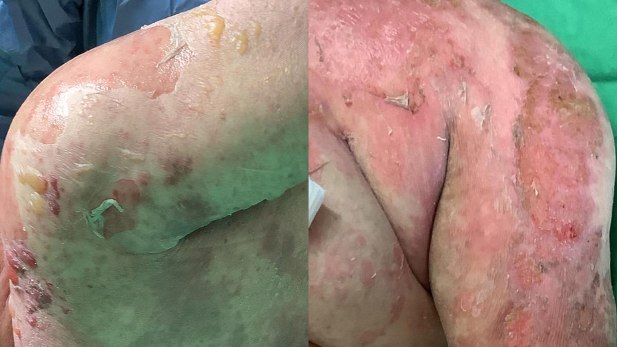 罹患史帝文強生症候群的病人全身會出現紅疹與水泡，死亡率2到3成。（示意圖，非當事人／台中榮總提供）