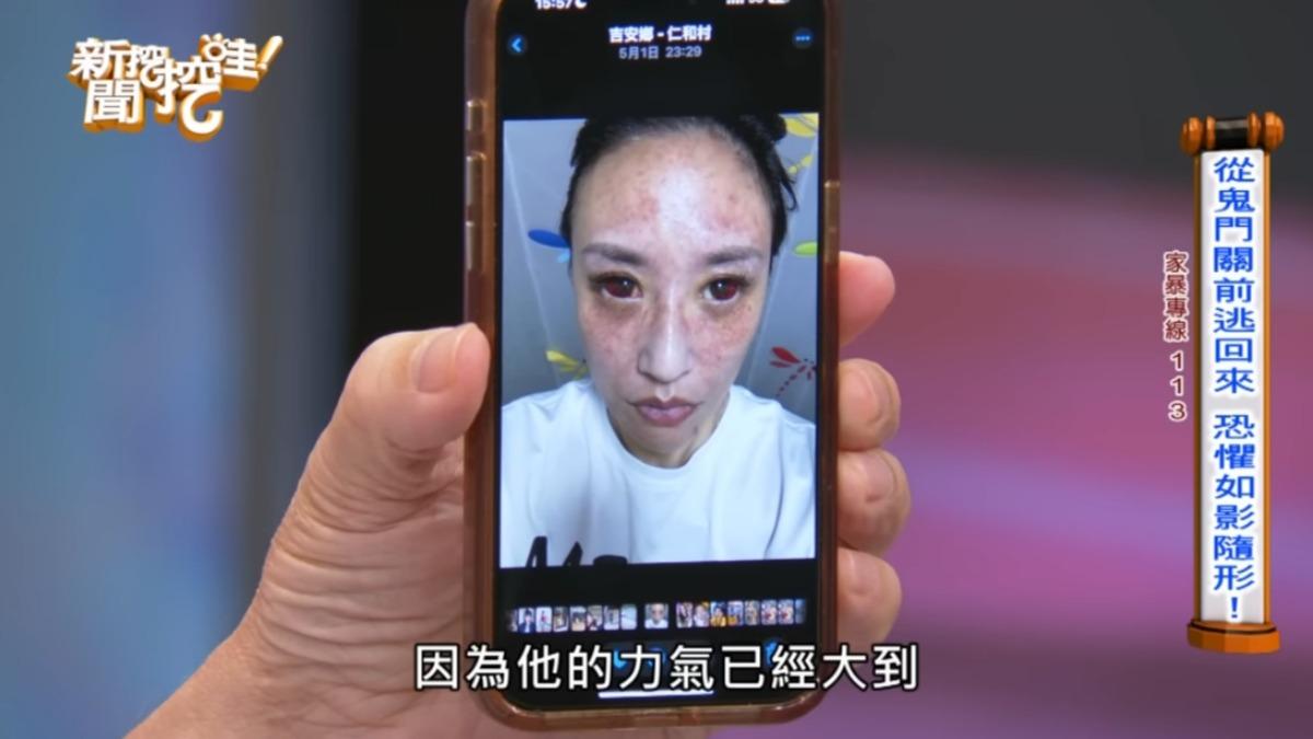 安歆澐公開自己受傷的照片。(圖/翻攝新聞挖挖哇YouTube)
