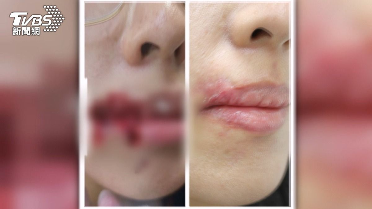 愛犬突翻臉!28歲女臉被咬掉4公分肉 「瘋柴」秒變暴君險毀容。(圖/民眾提供)