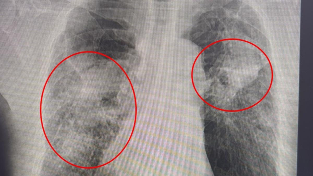 氣溫急凍發燒!台中男X光一照「胸全是白霧」 已流感重症