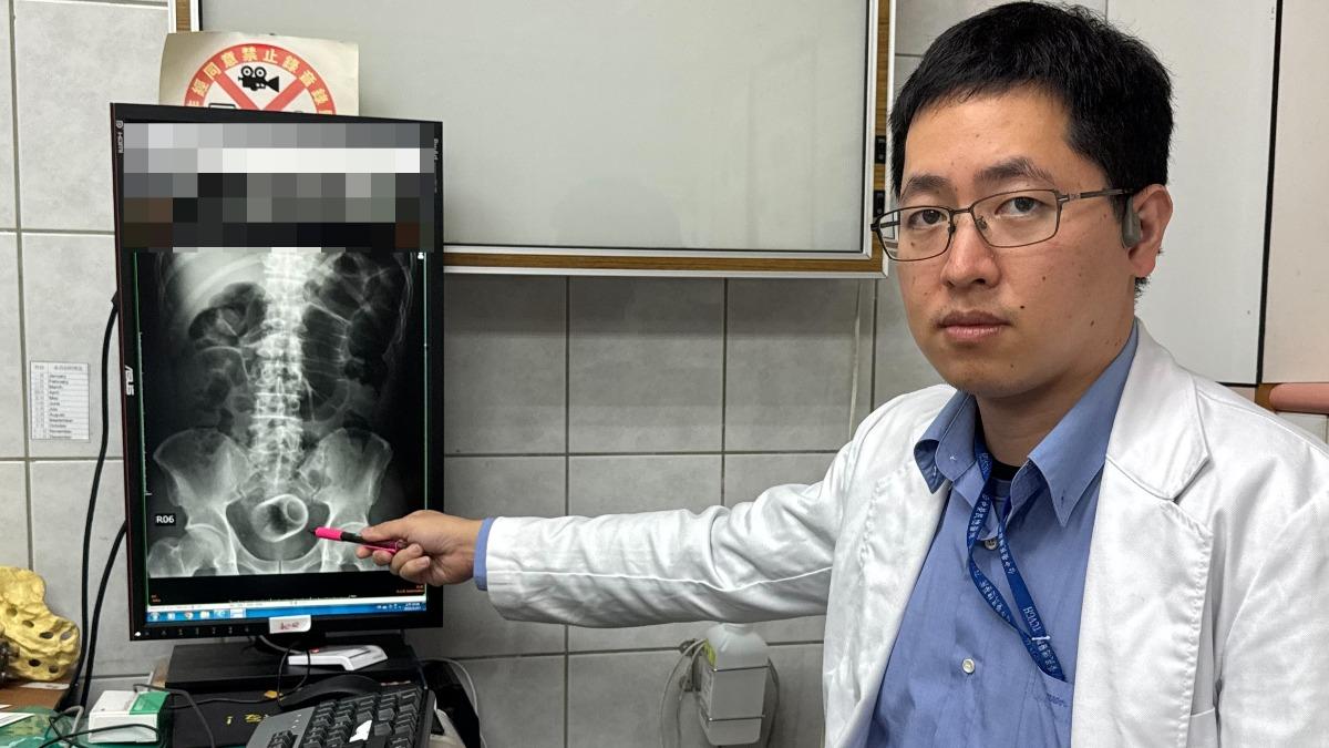 吳坤達提醒,臨床上肛門塞進異物,一般是基於好奇或想要尋求刺激,但將有嚴重後果。(圖/大甲李綜合醫院提供)