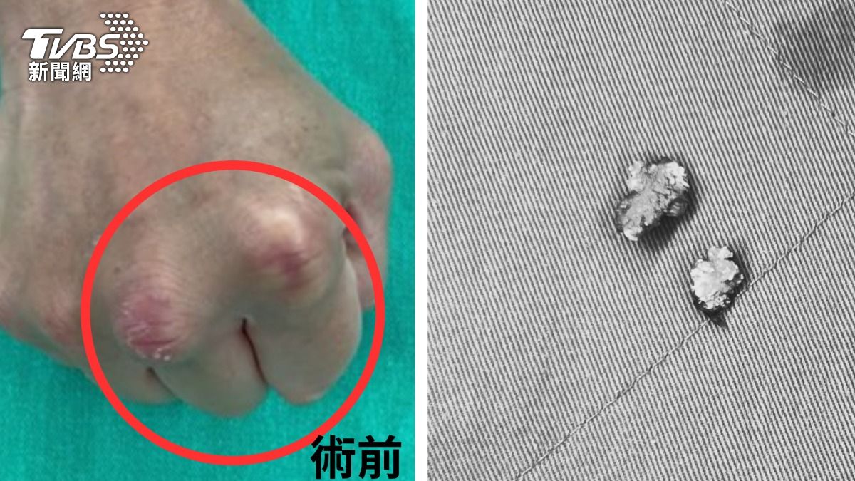 竹科工程師手指腫成花生!「痛風石」卡鍵盤2年 醫靠一招清光