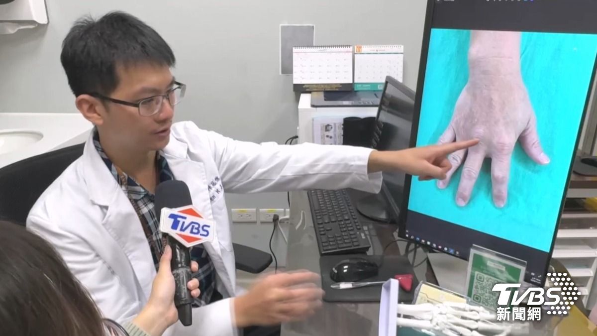 「痛風石」非普通結石 醫師:像卡身體裡的粉筆灰