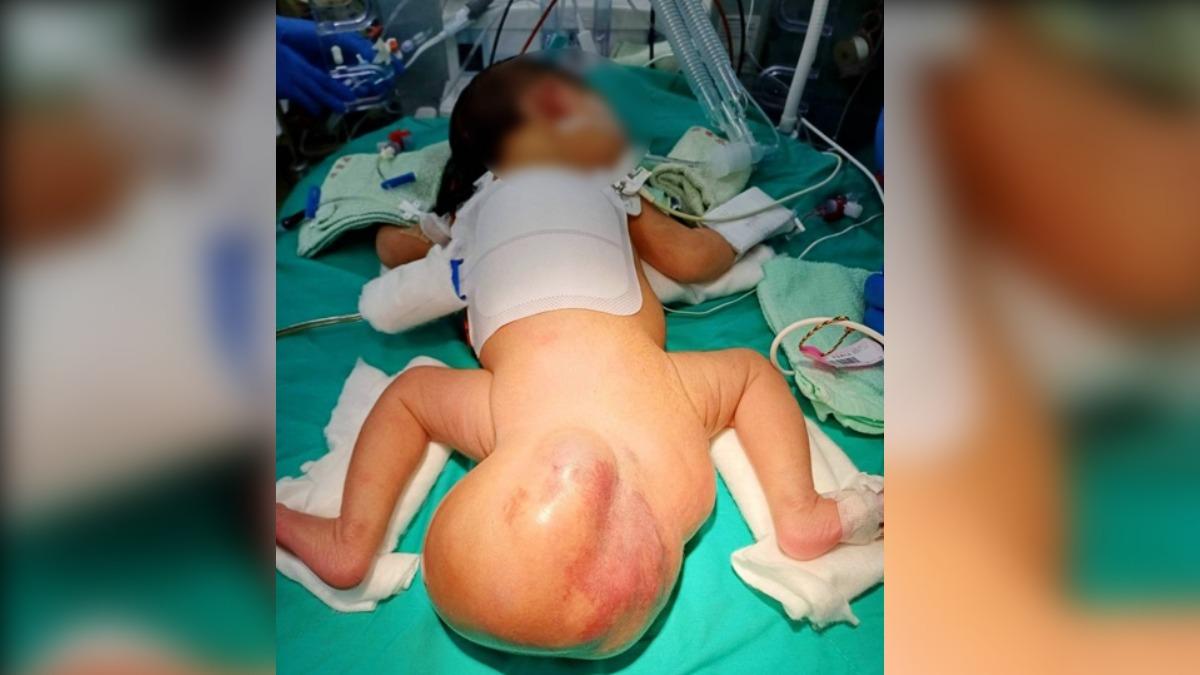 成因不明!台中女嬰患罕見畸胎瘤 出生「臀掛16公分巨球」