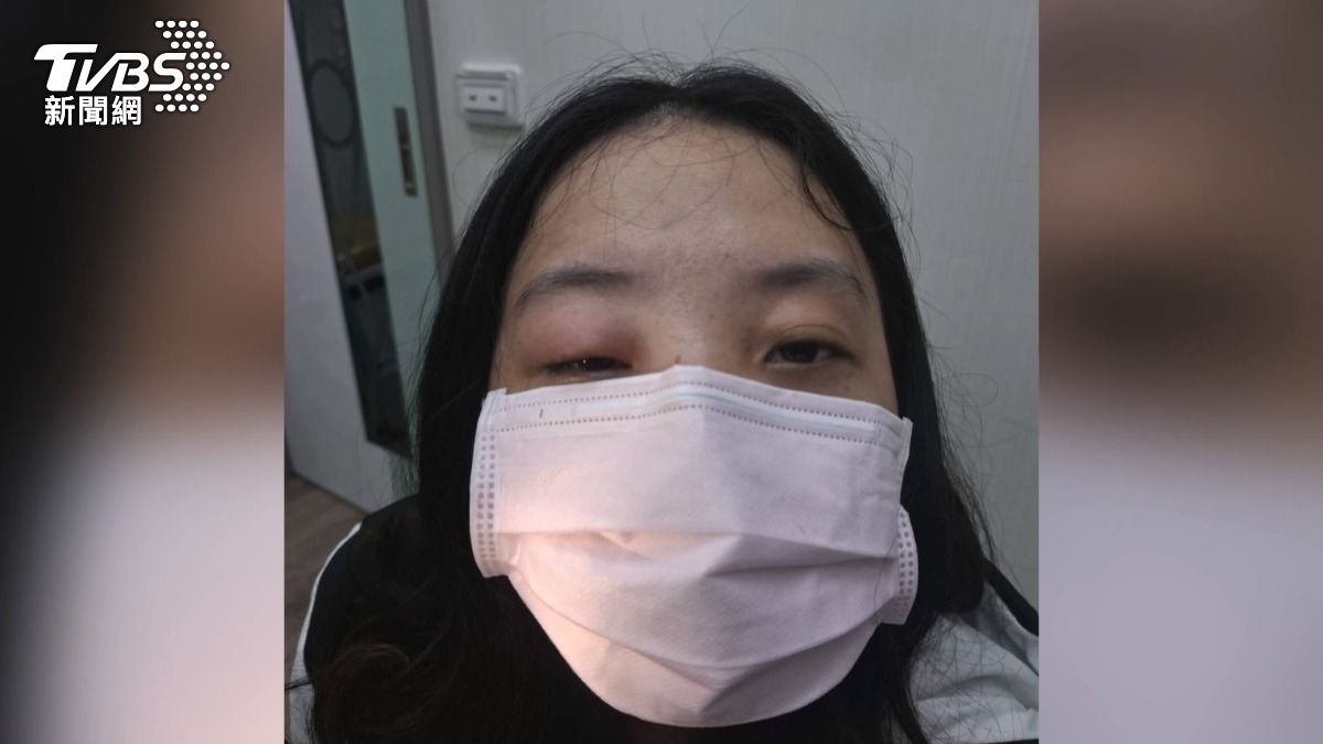 高雄一名25歲的江小姐,日前戴全罩式安全帽騎車,沒想到竟然被蜜蜂鑽入,眼皮上還插著兩根針刺。(圖/TVBS)