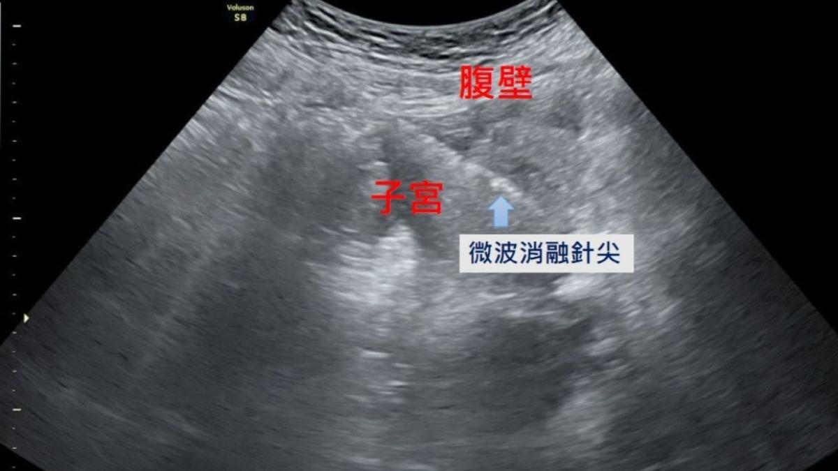 在腹腔鏡及婦科超音波的導引下，將消融針精準進入病灶，釋放高能量微波破壞異常內膜腺體組織，使其失去活性而逐漸縮小。（圖／慈濟醫院提供）