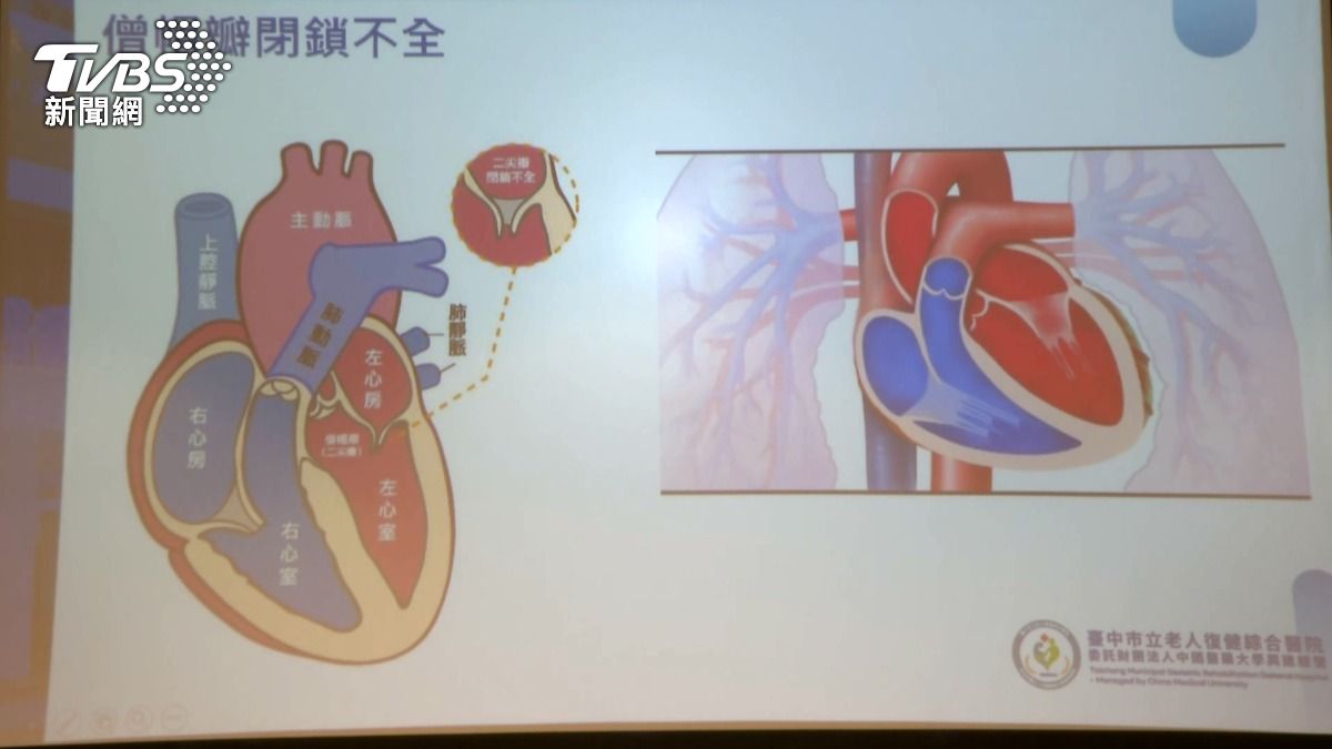 高齡長者出現腳水腫、易喘、夜咳等症狀,可能是心臟病警訊而非單純老化現象。(圖/TVBS)