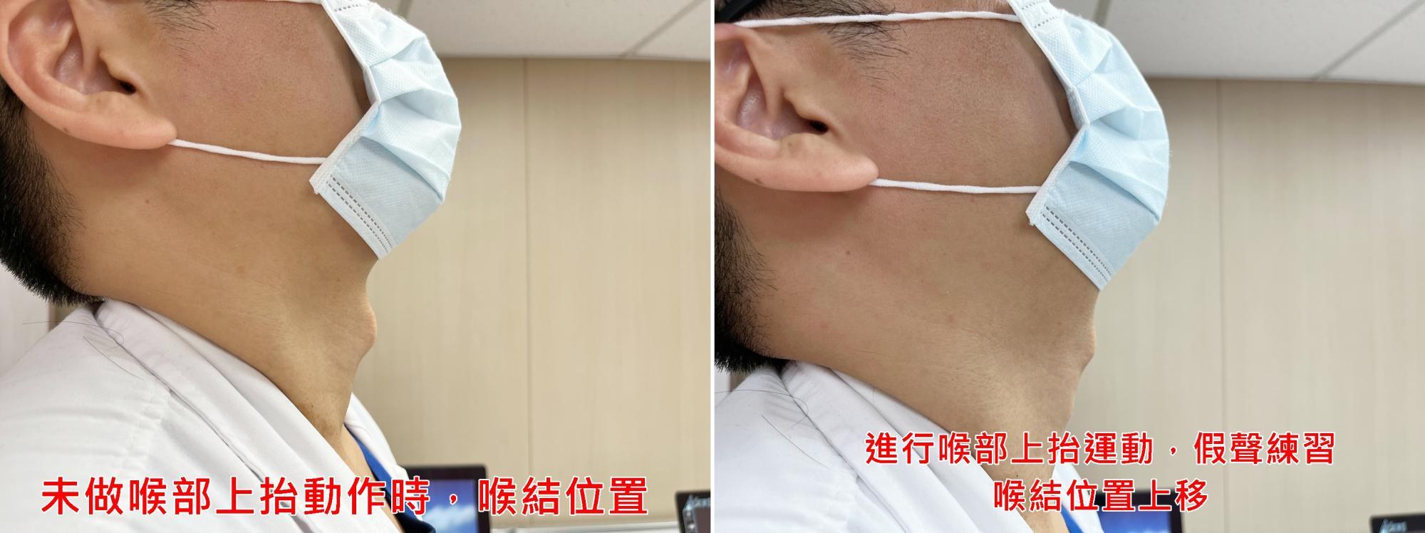 「喉部上抬運動」假聲練習時，可輕觸摸喉結感受喉部狀態。（圖／台北醫院提供）