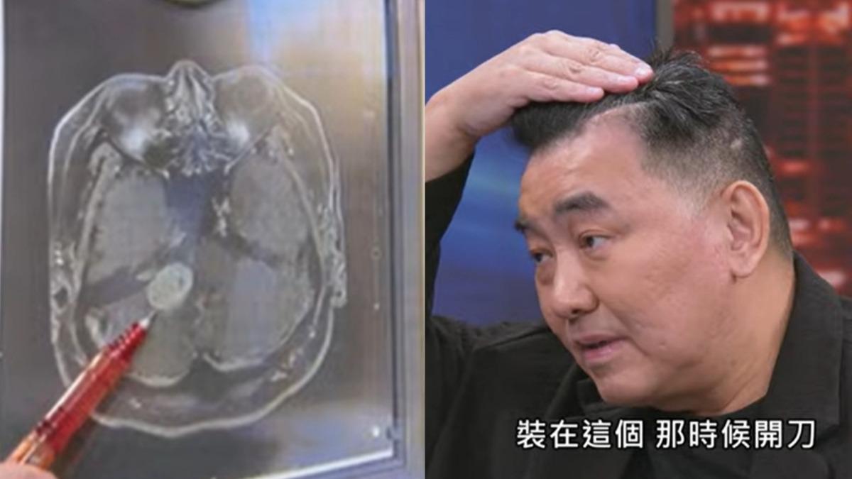徐亨欠債2億破產離婚！長3公分腦瘤「摘除恐半身不遂」　靠1儀器維生