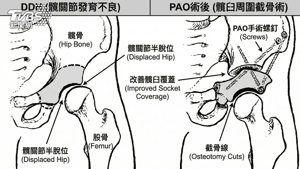 認識髖發育不全 (DDH):我的髖關節出了什麼問題?