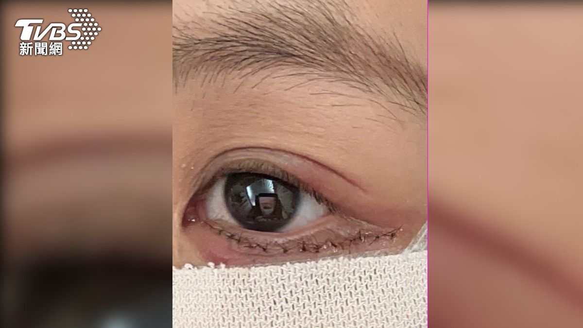 病患指控,眼下縫的針超過10針。(圖/當事人提供)