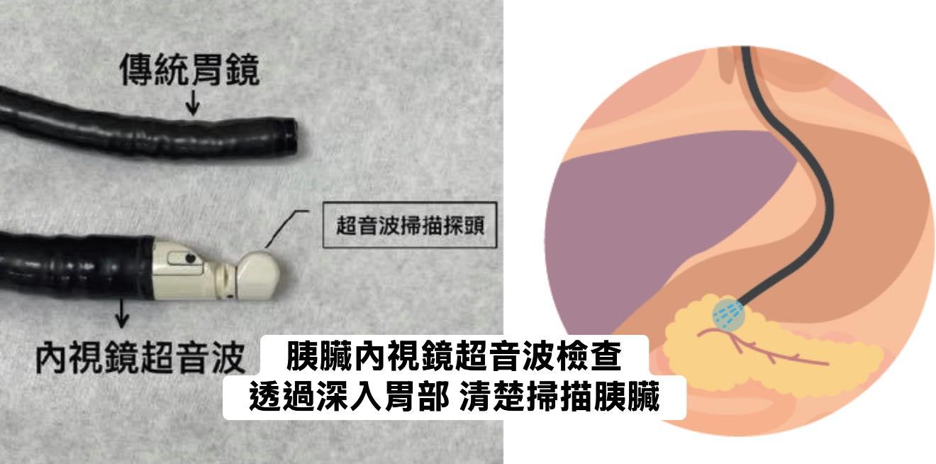 胰臟內視鏡超音波之所以看得清楚，是因為直接深入胃部。（圖／翻攝自林相宏臉書）