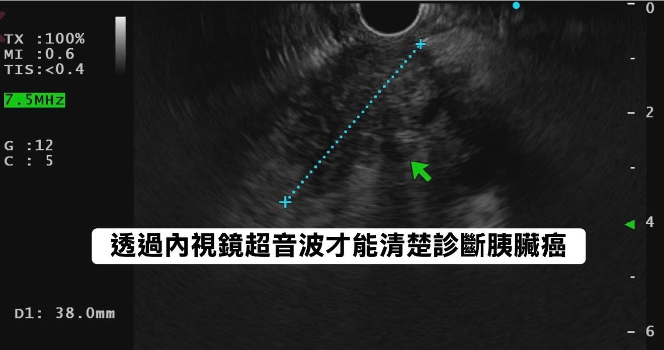 透過內視鏡超音波診斷出胰臟癌。（圖／翻攝自林相宏臉書）