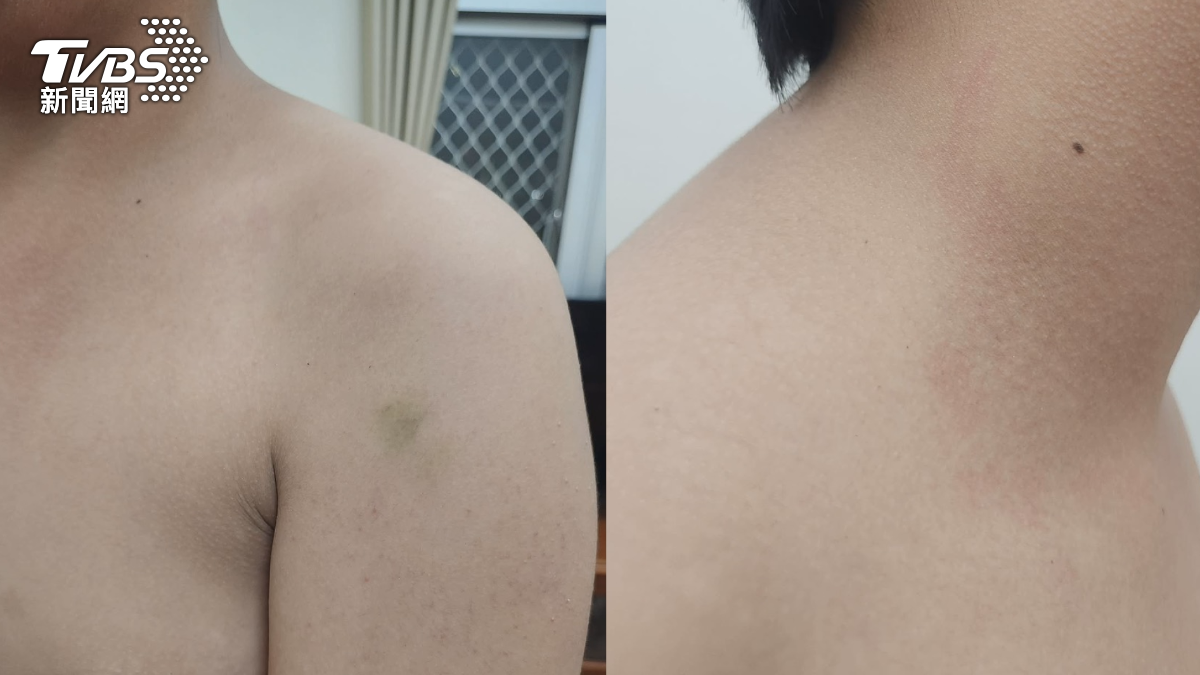 慶生變圍攻!國中生被綁欄杆攻擊,全身是傷,家長提告。(圖/當事人提供)