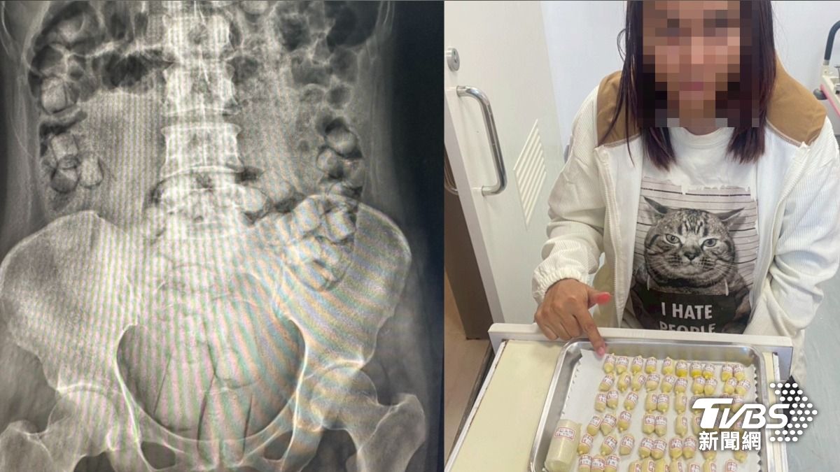 海洛因口吞、塞肛!2泰女藏115顆毒球運毒 灌腸虛脫判超重