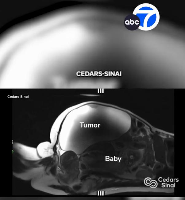 胎兒幾乎壓迫著巨大腫瘤,屁股還抵著子宮。(圖/翻攝自X@abc7newsbayarea)