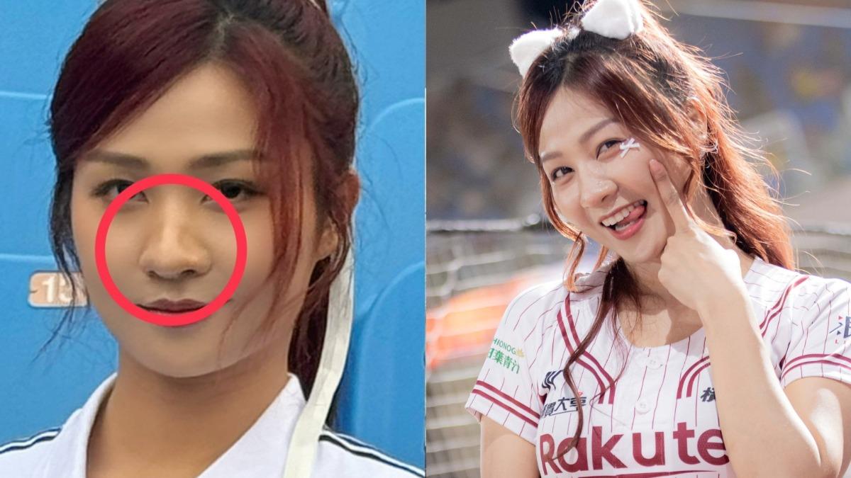 樂天女孩「鼻樑變S型」出事!拋重大決定 割肋骨軟骨修復