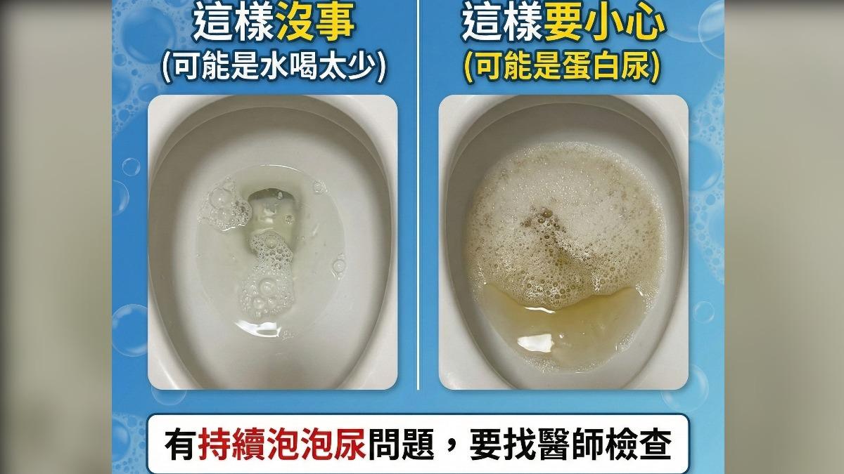 泡泡尿不等於腎虧 泌尿科醫師圖解教你看懂「腎病蛋白尿」