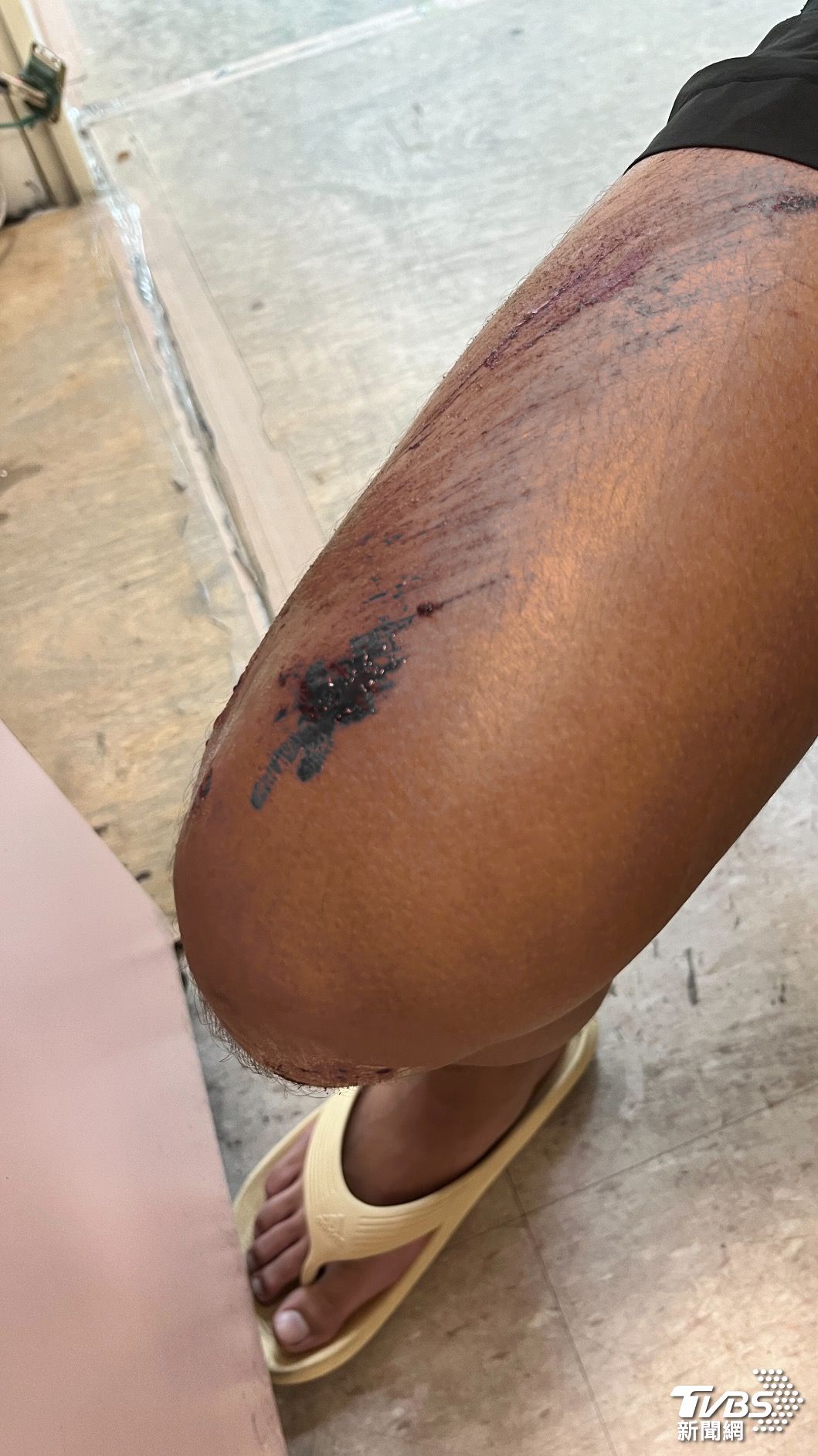 台東3名學生三貼騎車自摔,有的破相血流滿面、有的腿部大面積擦傷,校長第一時間發現卻未協助就醫。(圖/讀者提供)