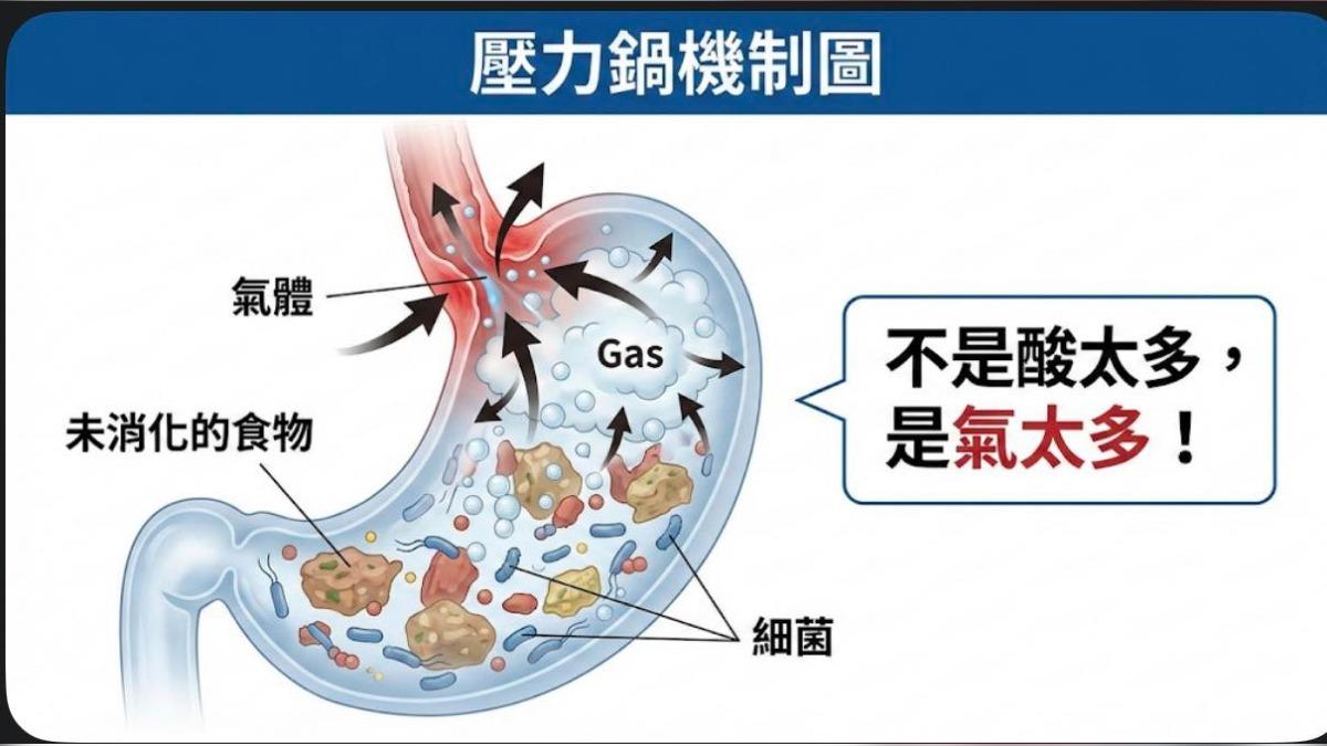 服藥半年胃食道逆流沒改善「停藥馬上好」 醫師點出「氣太多」