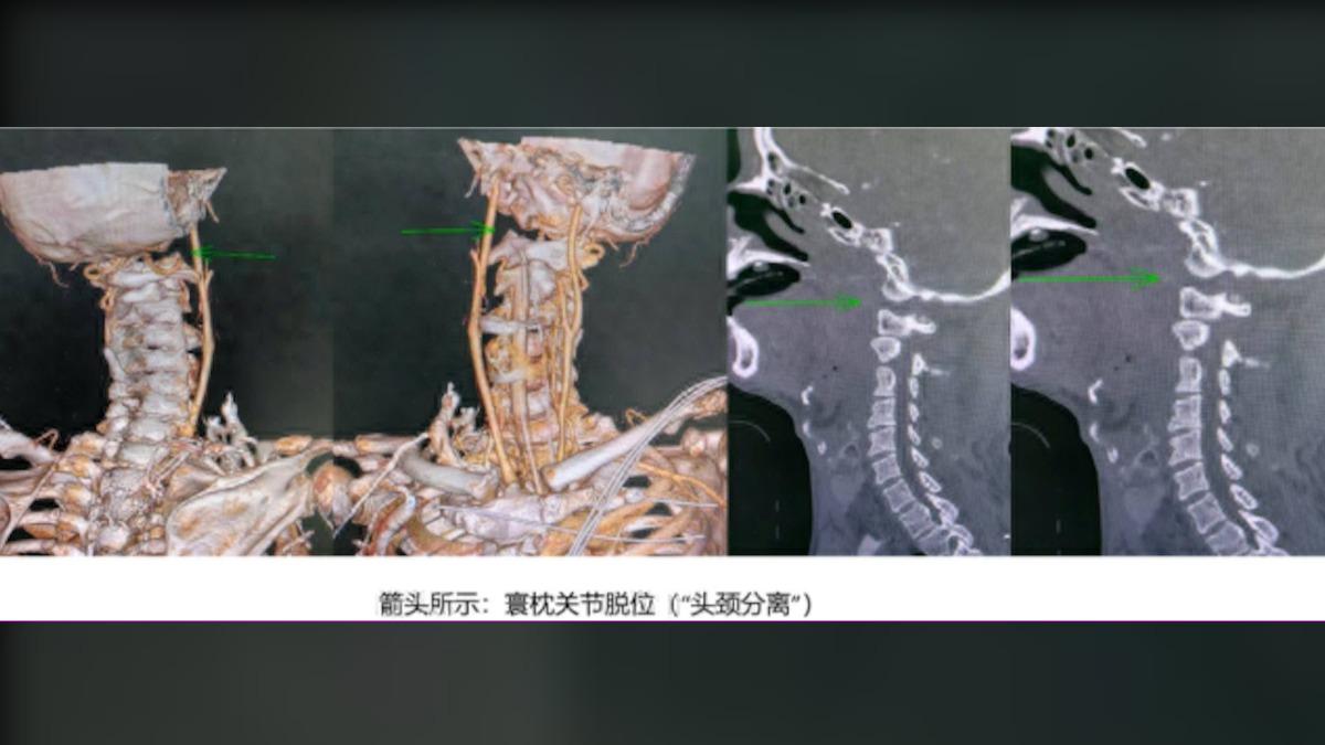 醫學奇蹟!廣州6旬翁「頭頸分離」 高難度手術保命:已能行走