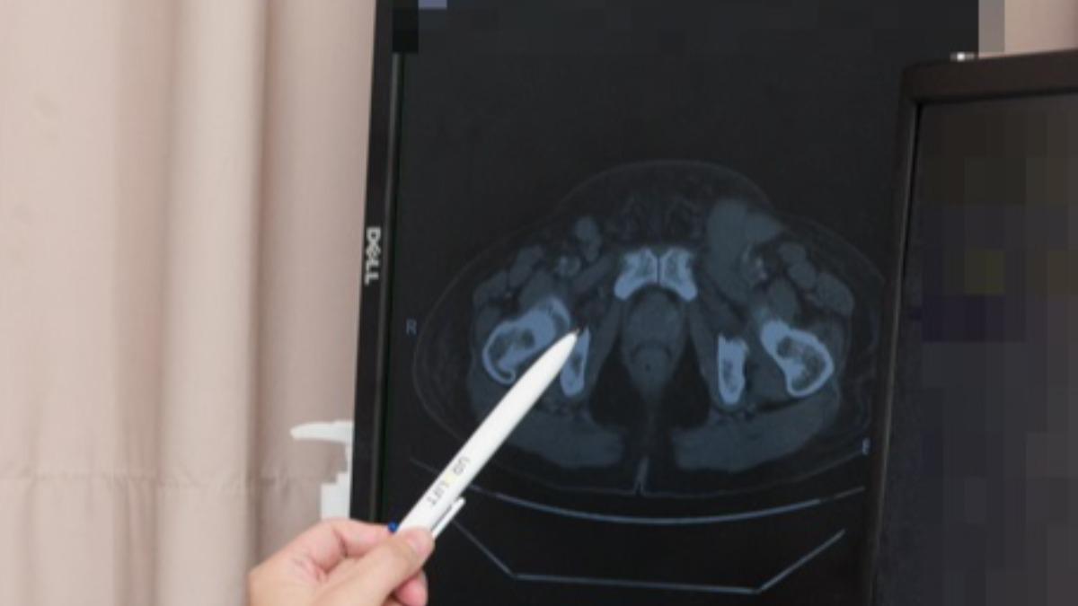 腹痛腿腫久沒好…台中女全身一照「滿是腫瘤」 5徵兆慘了