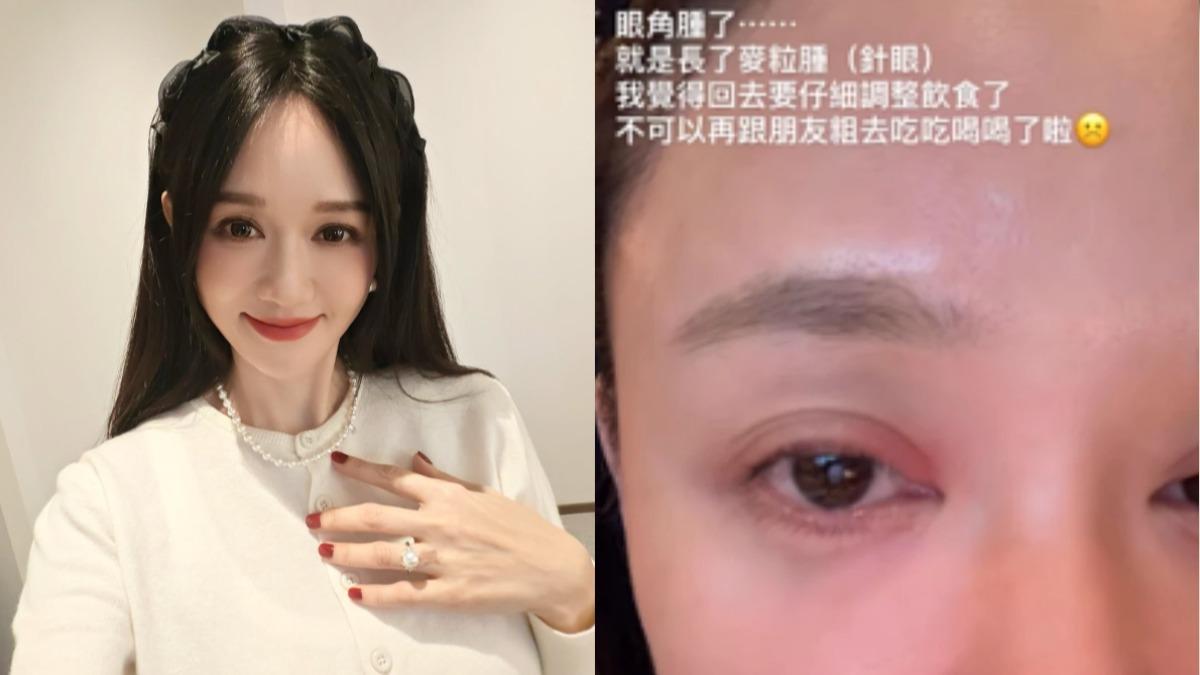 陳喬恩自爆「眼角長怪物」！5習慣易長麥粒腫　預防針眼這樣做