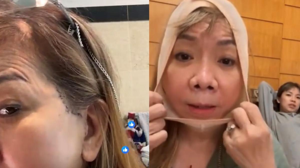 黃鐙輝丈母娘開刀!65歲萁媽拆繃帶秀「臉上縫線」 脖子大片瘀青
