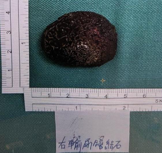 張翁右側輸尿管與腎臟交界處有顆4公分巨大結石,左腎也有顆1.5公分大結石。(圖/台中醫院提供)