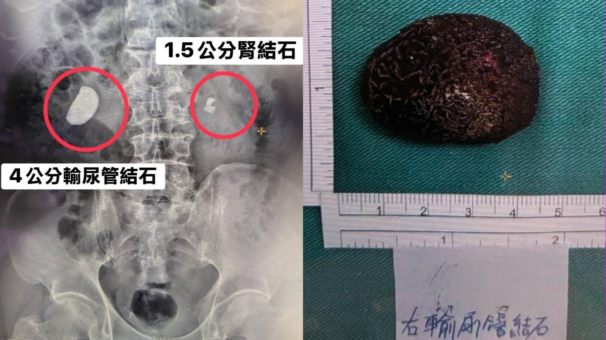 每9人就1人中!台中翁無視腰痛拖到血尿 一照驚藏2顆巨石