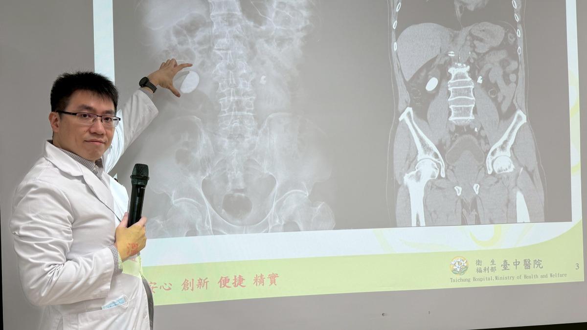簡維弘強調,預防結石最好的方法是喝水,成年人每天至少應攝取2000CC開水。(圖/台中醫院提供)