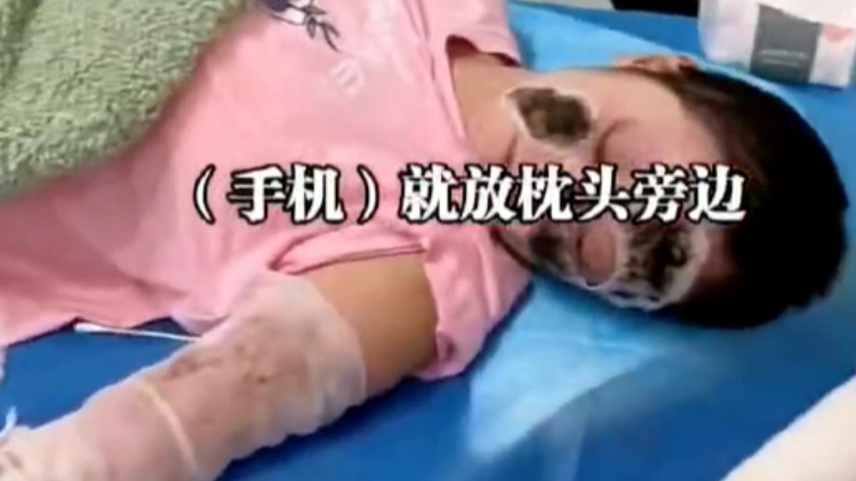 手機枕頭旁充整晚「充電頭突爆炸」 陸女慘遭毀容、全身燒燙傷