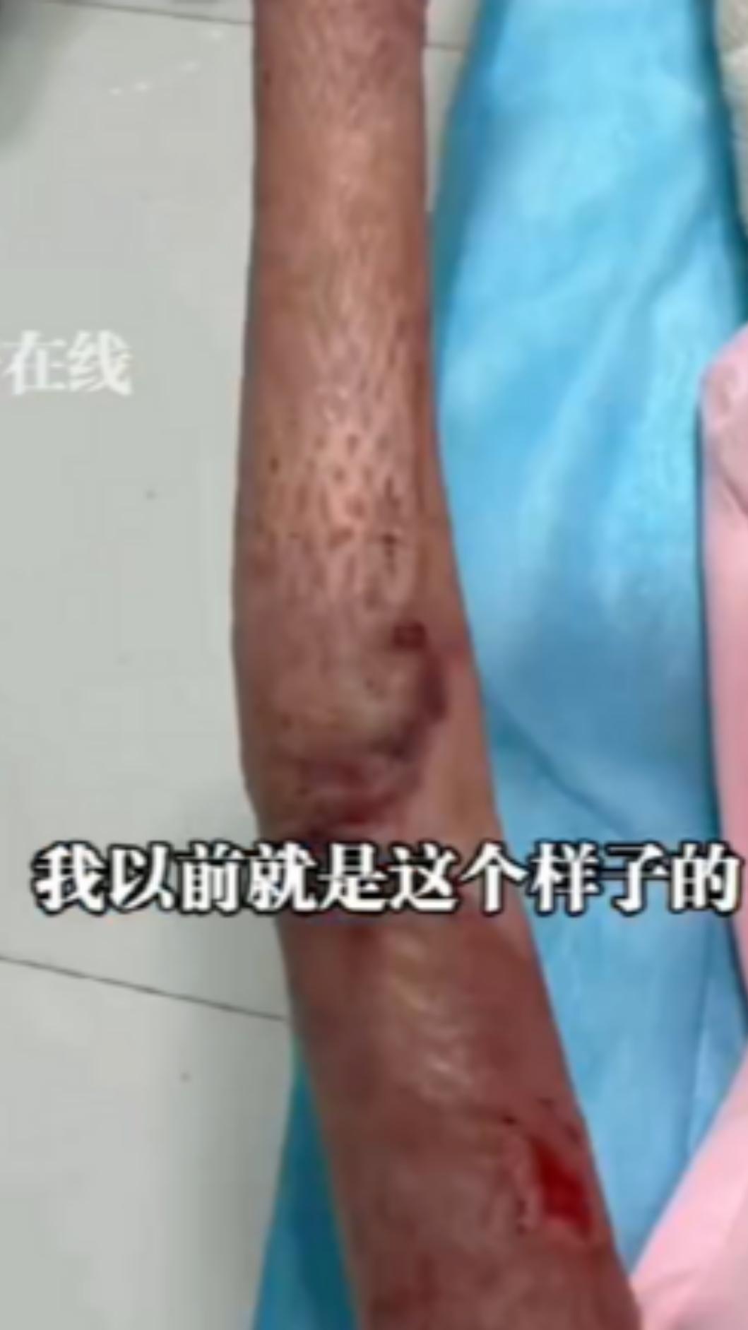 此意外造成女子全身嚴重燒燙傷。（圖／翻攝自微博）