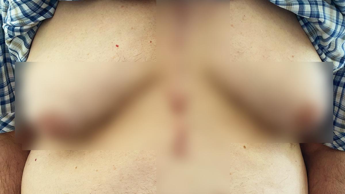 七旬翁女乳症乳房發育畫面曝 研究揭與服用這款常見處方藥有關