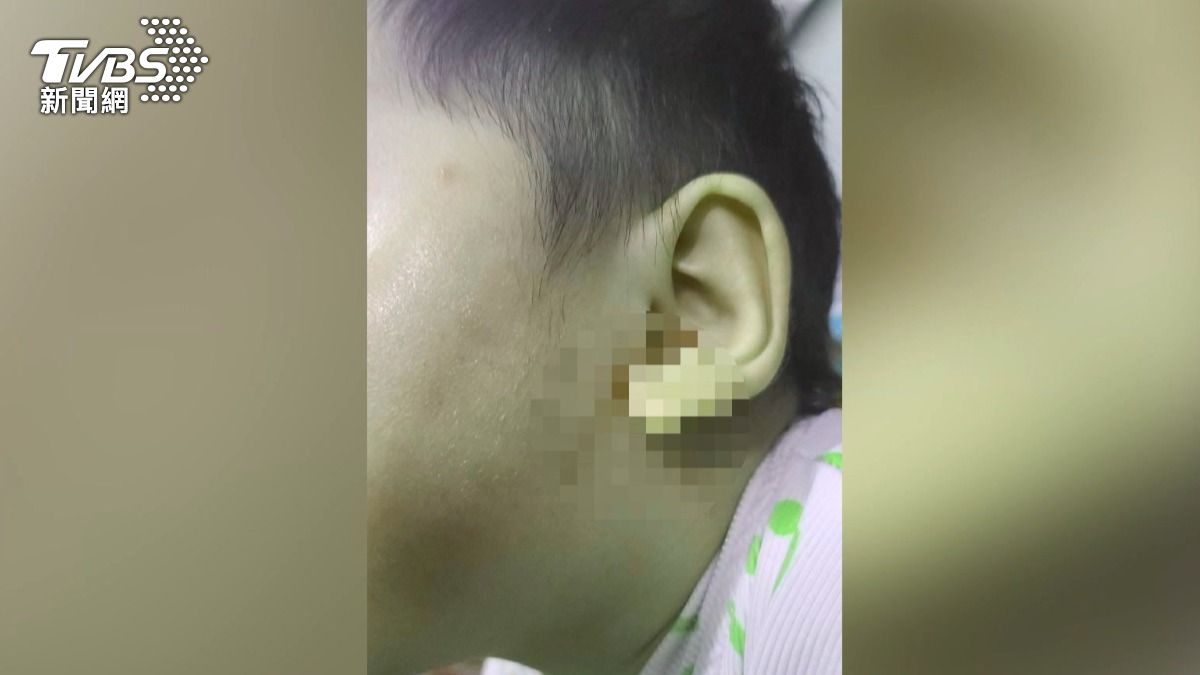 孩子被虐待超過20次,孩子從臉部、脖子、耳下到處都是瘀青,胸腔和腹部也受傷。(圖/TVBS)