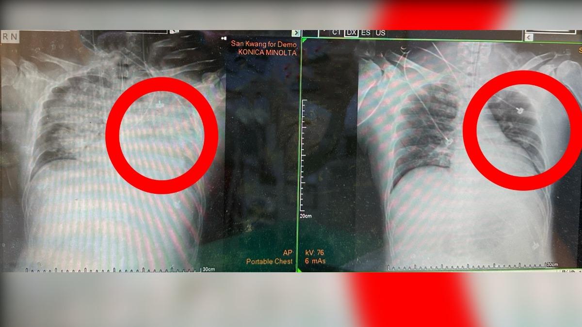 一杯珍奶險鬧命！台中男喝太快嗆咳　秒「臉發紺腦瘤破」昏迷