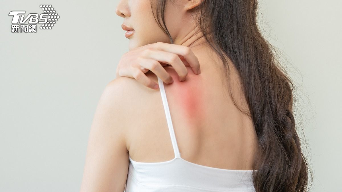 擦乳液還是超癢?專家揭「冷型蕁麻疹」誘因:補對5營養不再抓