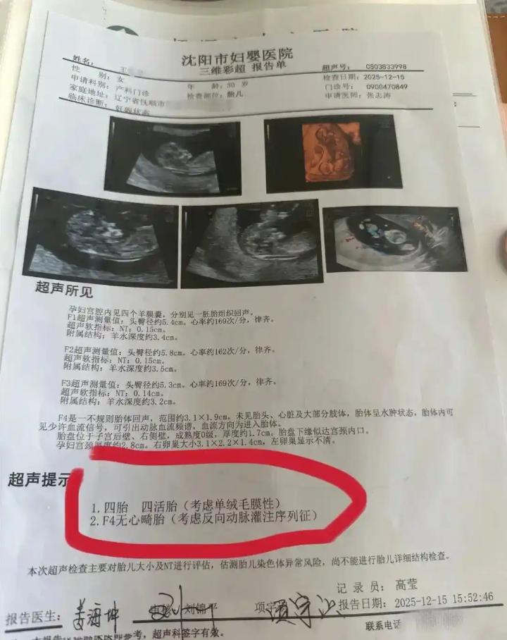 最終共有4胎，最後被發現的為畸形胎。（圖／翻攝極目新聞）