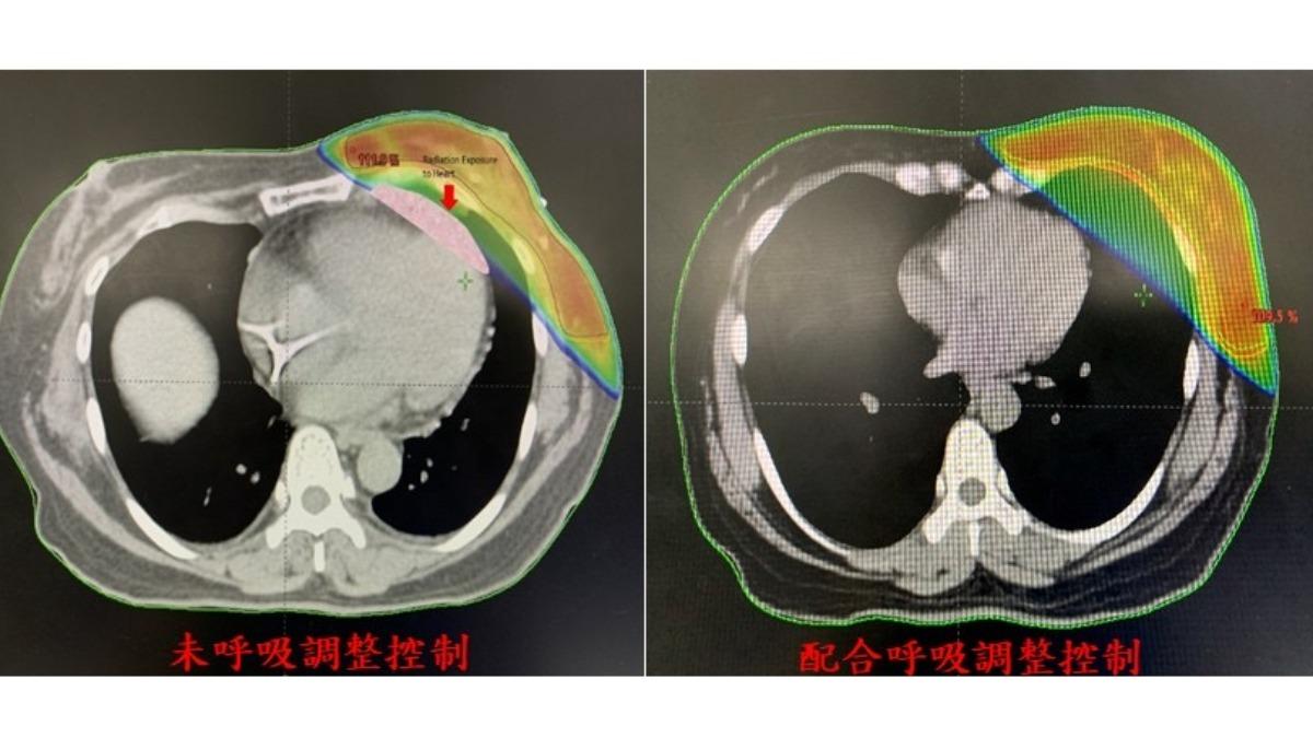 左乳摸起來硬硬的！台中女害羞不敢看病　拖半年變癌症了