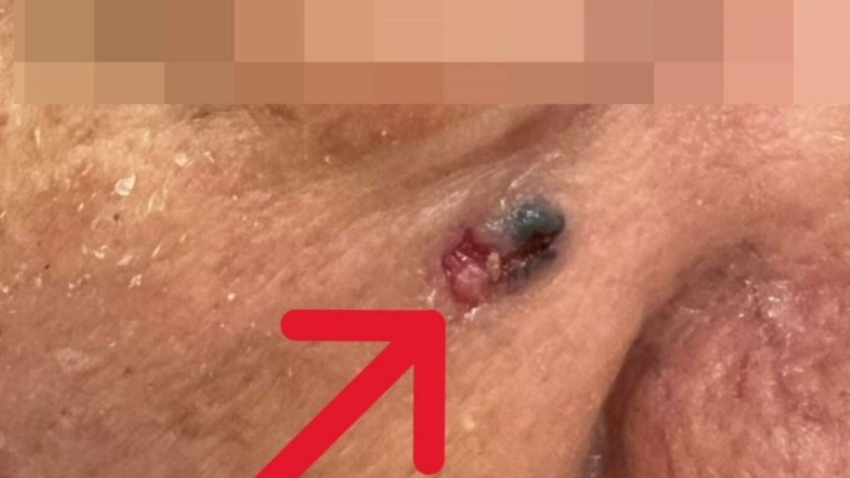 患者臉部黑斑變嚴重,結果是皮膚癌。(圖/醫院提供)