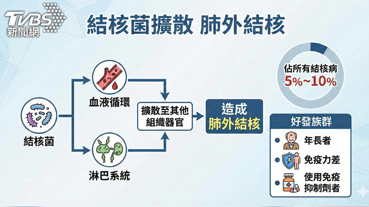 肺外結核常合併「肺結核」! 醫:確診肺外也要照X光