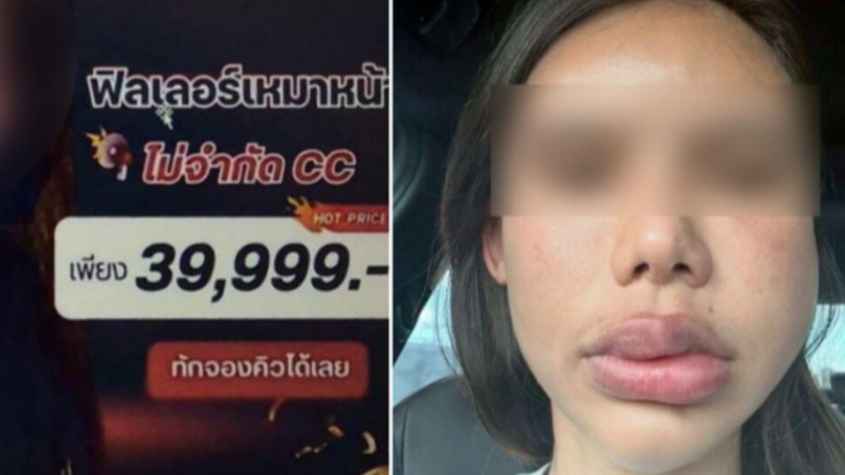 醫美出包!泰女打玻尿酸「臉腫2年」 指控疑假醫師操刀