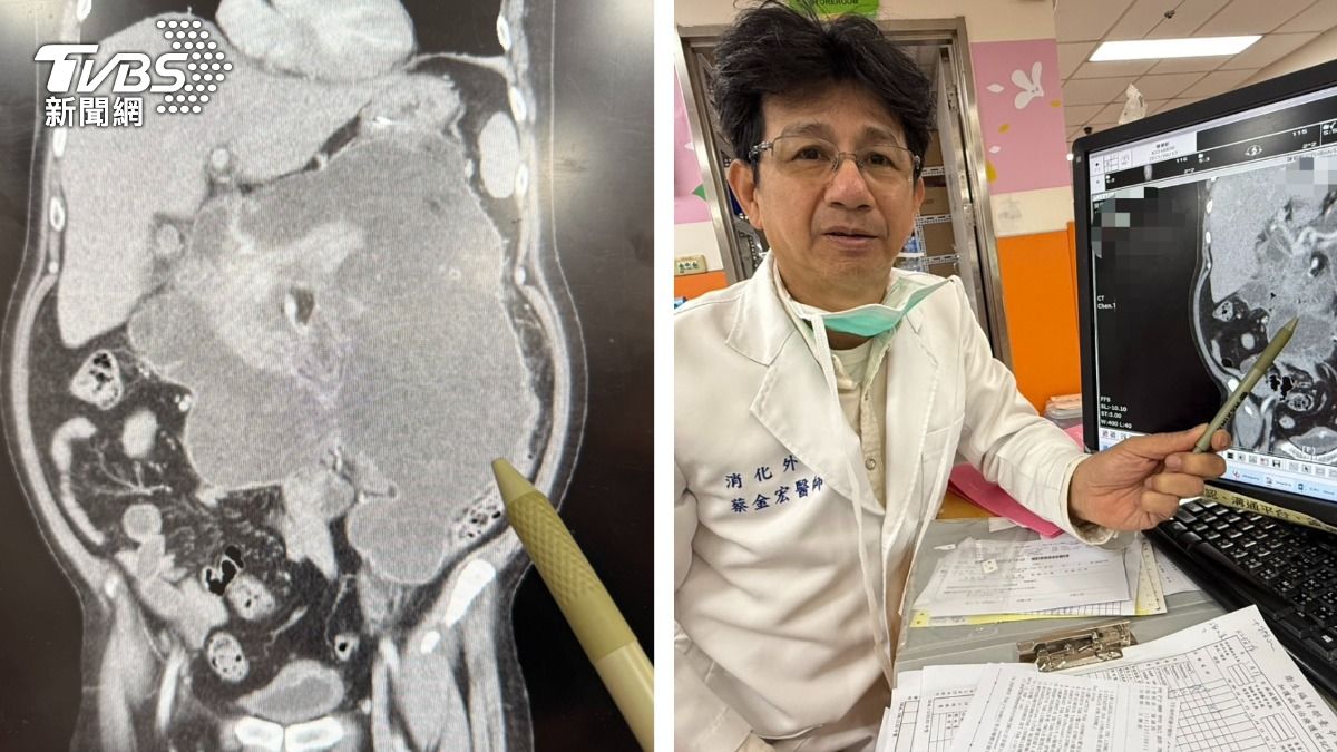 戒酒4年!台中男主廚腹痛到無法呼吸 十二指腸穿孔休克