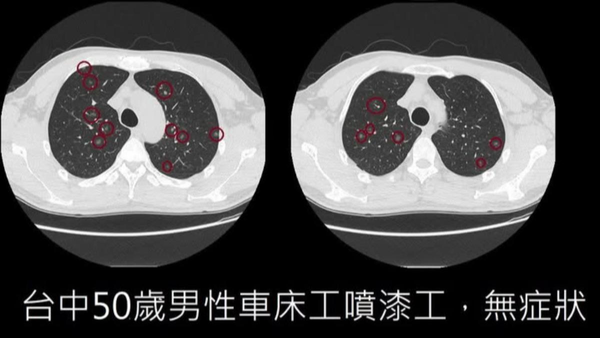 無症狀!50歲男健檢照出「上百粒肺結節」 醫嚇壞:開刀無法處理