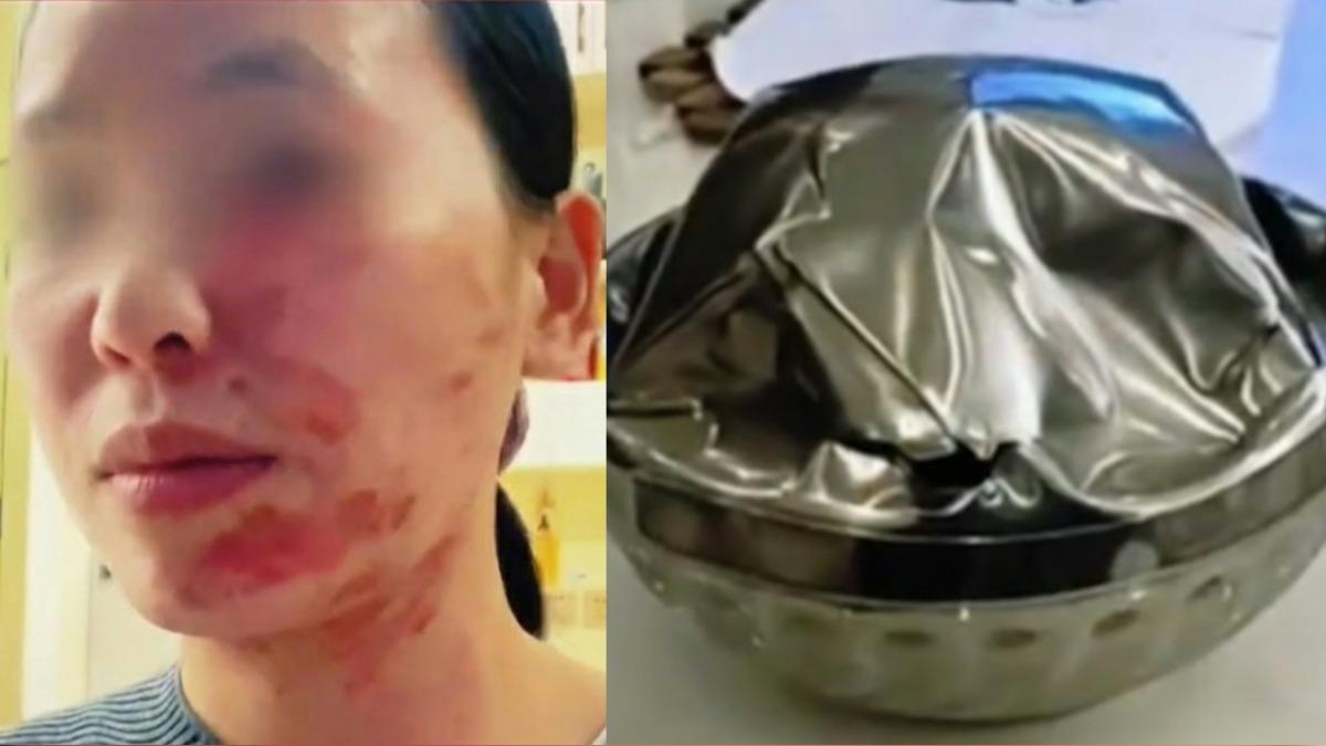 不鏽鋼碗爆炸！她拿碗裝熱油「當場毀容」　3種碗不能用