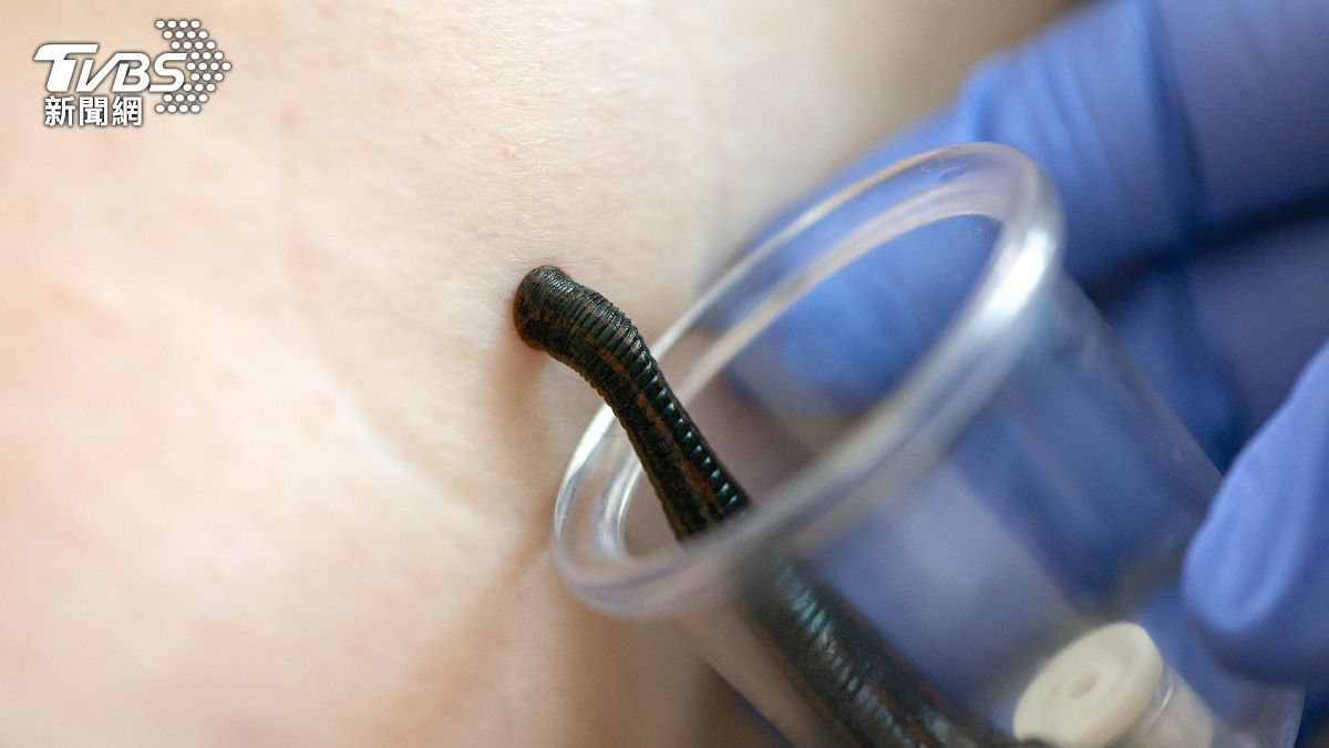 水蛭緊緊吸附在男子的膀胱黏膜。(示意圖/shutterstock達志影像)