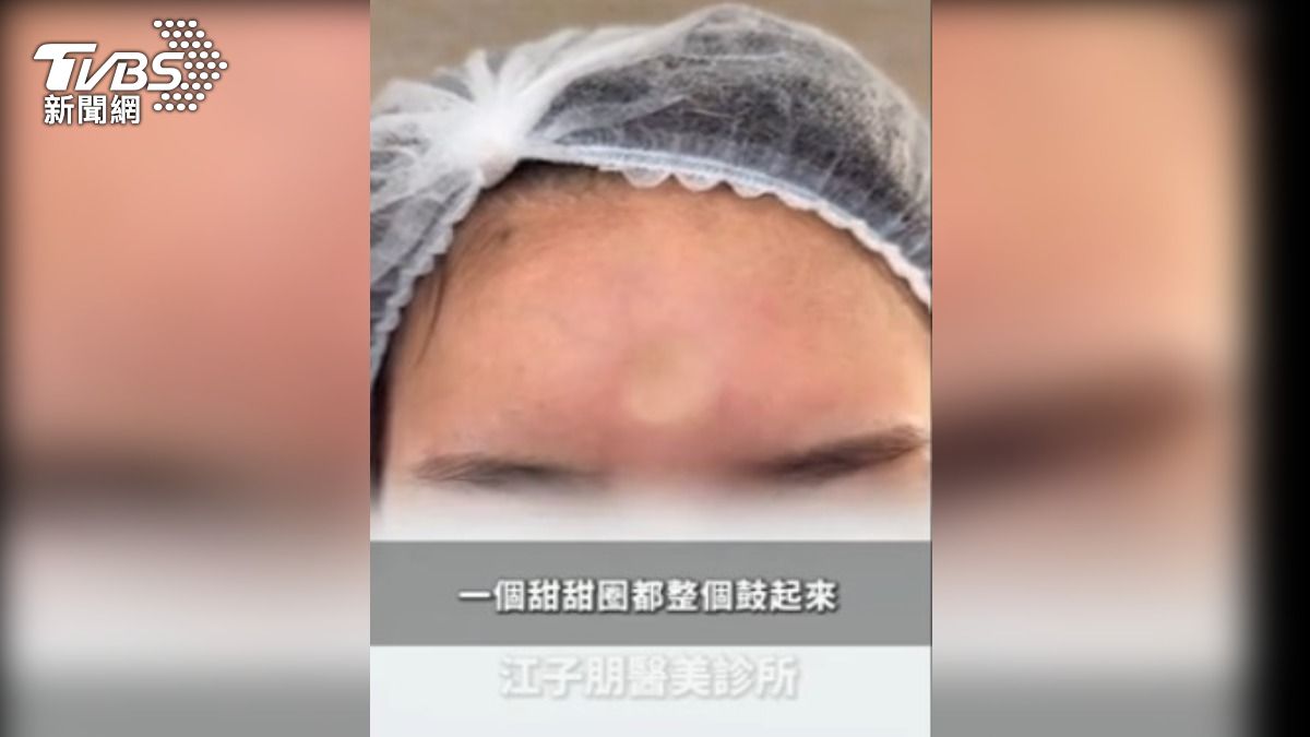 民眾到韓國花１０萬打填充物，卻產生後續問題。（圖／江子朋醫師提供）