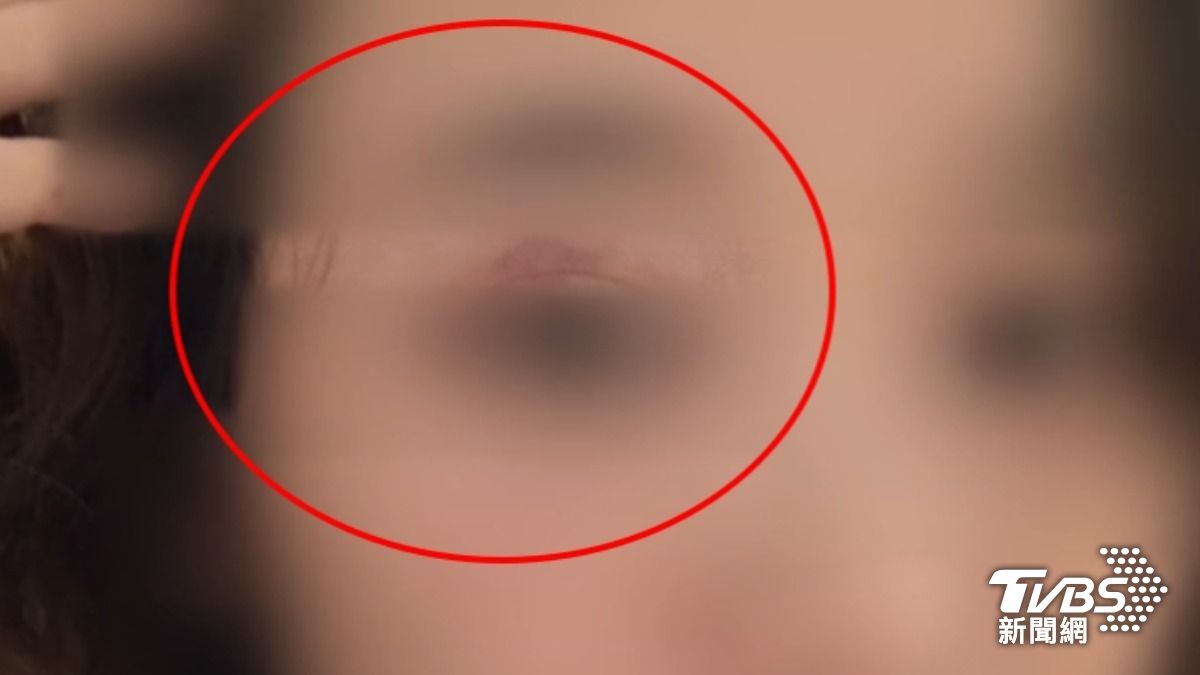 女子控訴遭前男友動粗，眼皮瘀血，手腳都有受傷，已到醫院驗傷提告。（圖／TVBS）