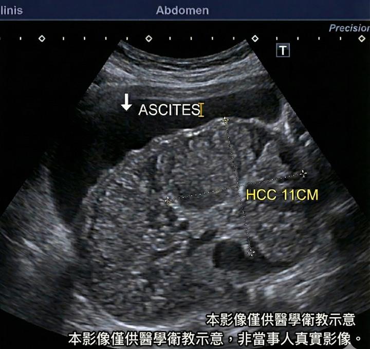 醫生提醒，肝臟沒有痛覺，等到它把肚子撐到「脹」時往往是晚期。（非當事人畫面／翻攝卓韋儒醫師臉書）